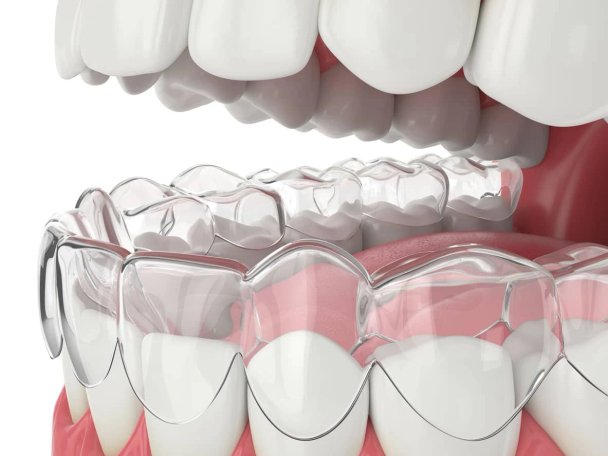 A picture of dental clear aligners