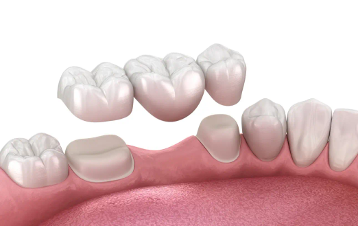 Illustration showing a dental bridge placed to replace a missing tooth using the surrounding teeth for support