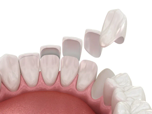 Illustration showing dental veneers being placed over natural teeth to improve shape and appearance