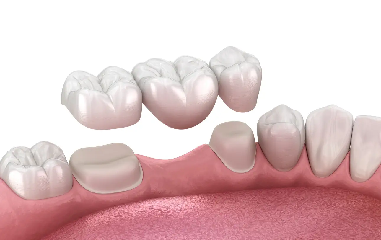 dental bridge model showing replacement teeth