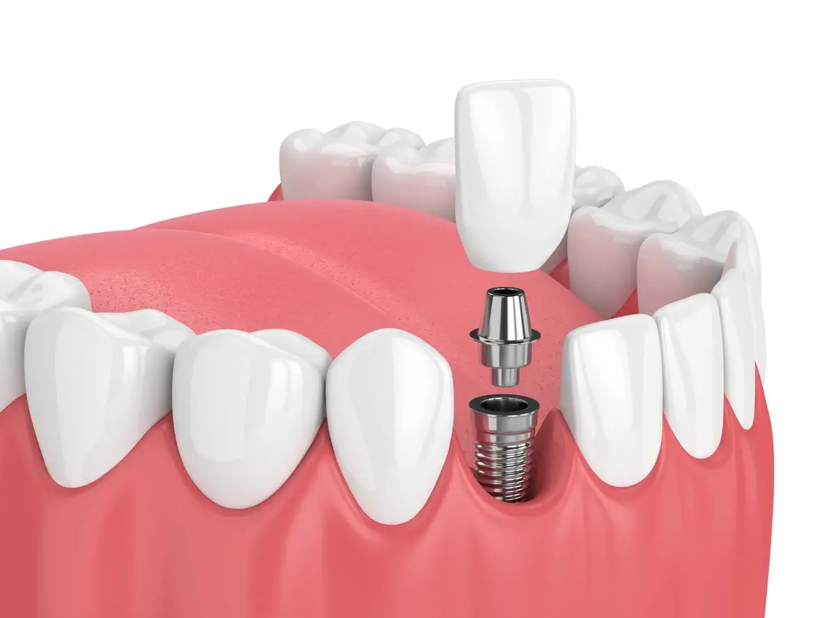 dental implant model showing titanium post and crown