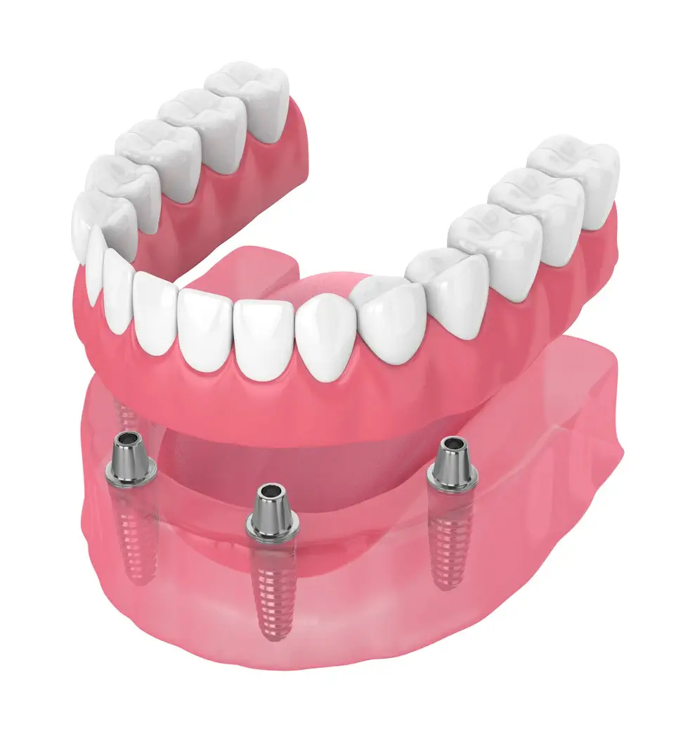 full set of custom dental dentures
